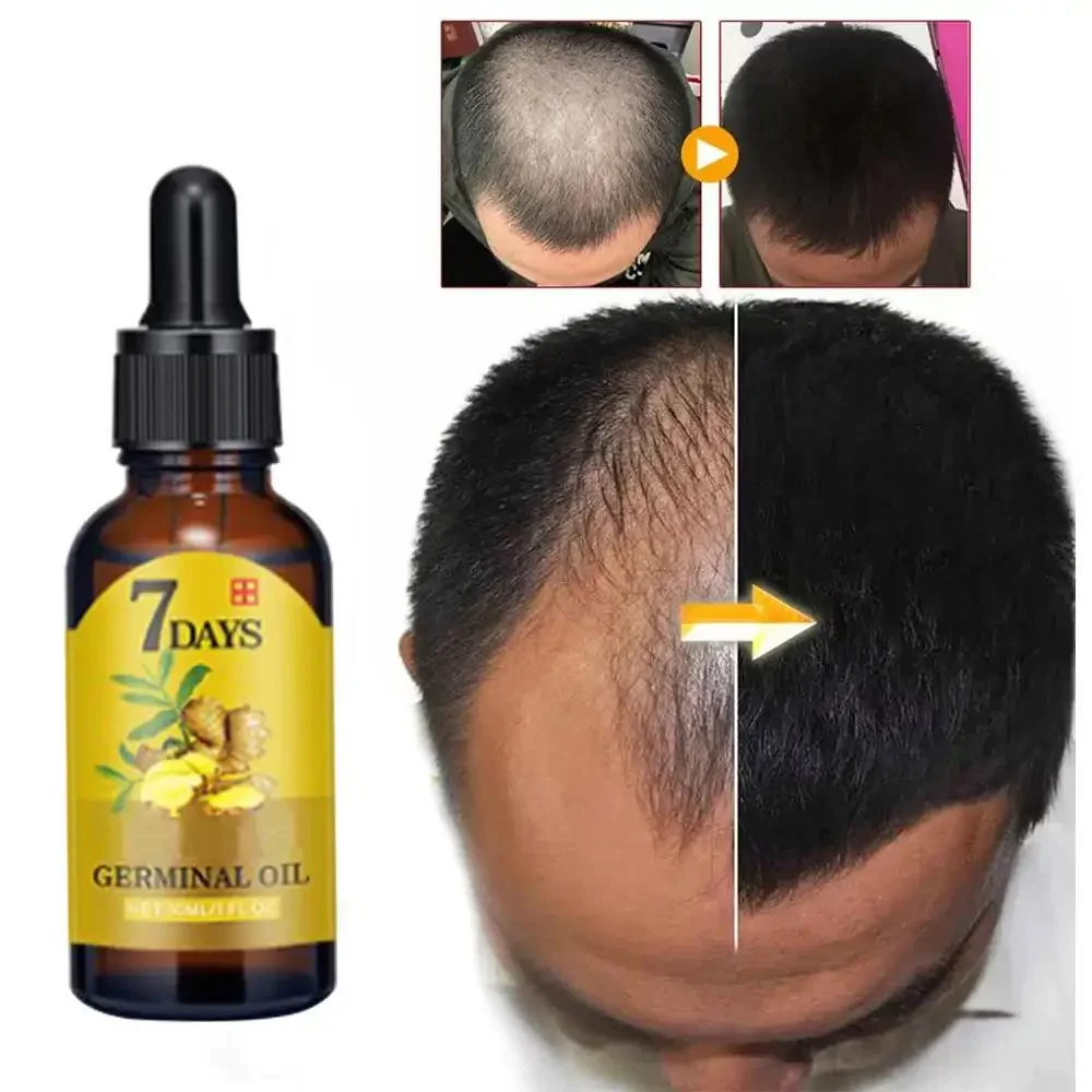 Hair Care Essential Oil Atomizing - نمو الشعر الزنجبيل سريع النمو زيت