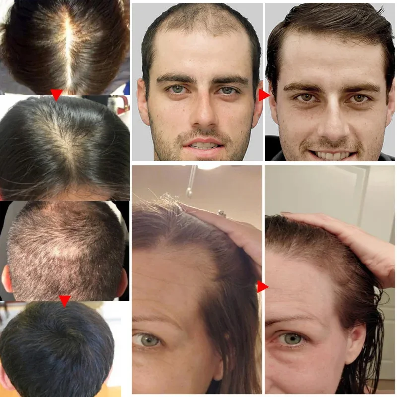 زيت عطري لنمو شعر الزنجبيل ، م - مراجعة Hair Care Essential Oil Atomizing وسعره