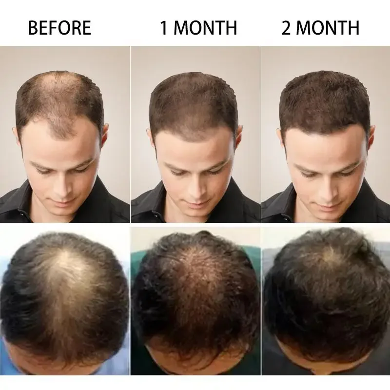 نمو الشعر الزنجبيل سريع النمو  - مراجعة Hair Care Essential Oil Atomizing وسعره